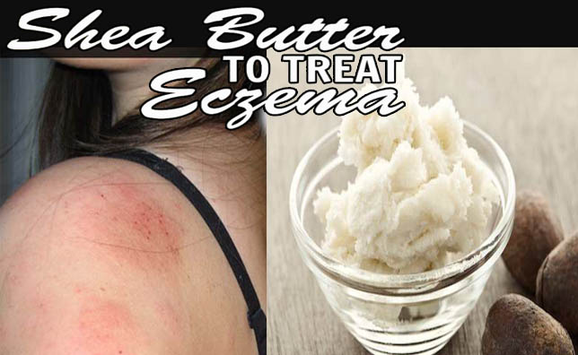 Shea butter for eczema