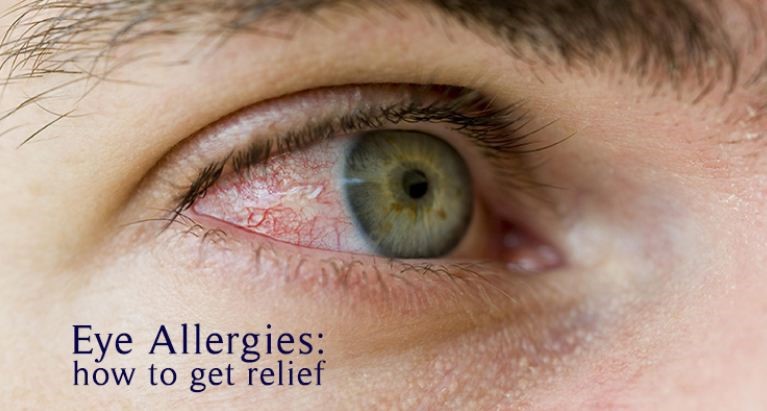 How to Get Rid of Eye Allergies? | Symptoms and Treatments