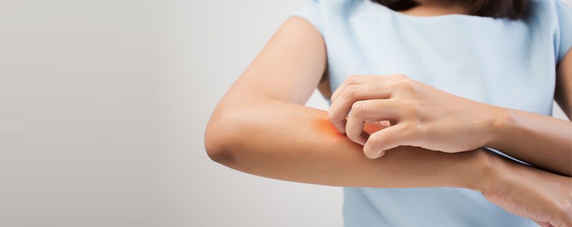 7 Home Remedies That Will Help You Get Rid of Skin Allergy & Itchy Reaction