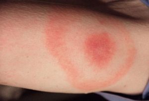 mosquito bites symptoms
