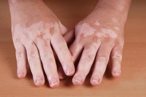 white spots on hands