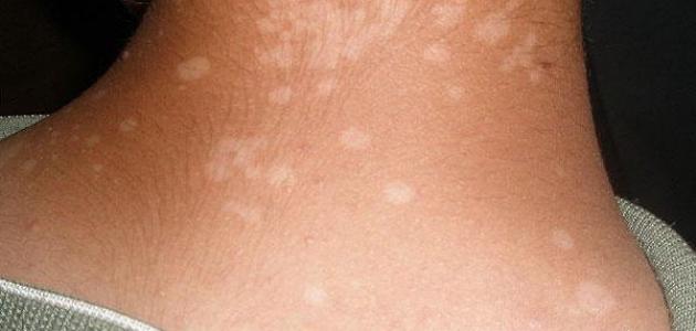 White patches on the skin [6 Natural Remedies]
