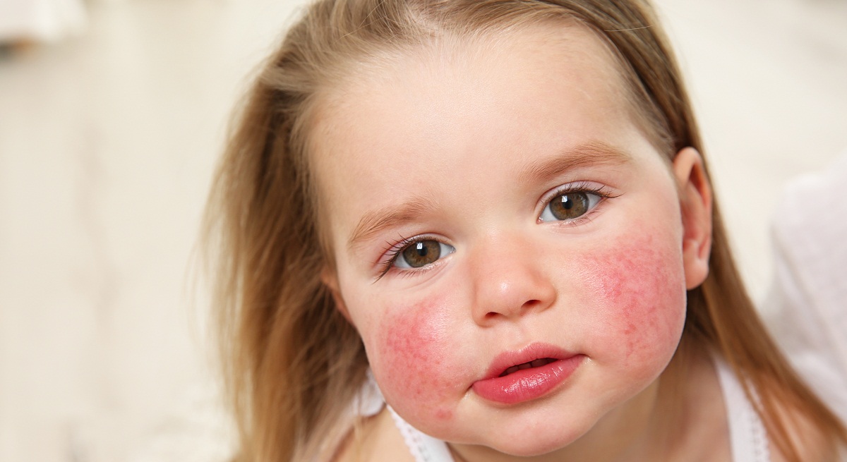 The causes of the emergence of Allergy in children