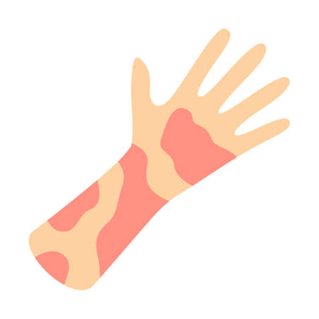 Photodermatitis (Sun Allergy Rash): Symptoms, Causes, and Treatment Options