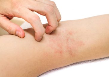 Allergic-contact-dermatitis symptoms