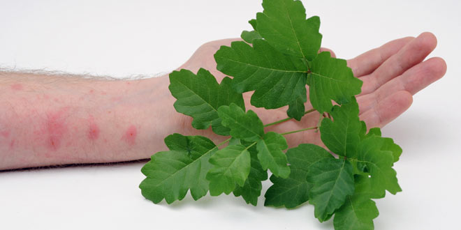 A Simple Guide To Allergic Contact Dermatitis