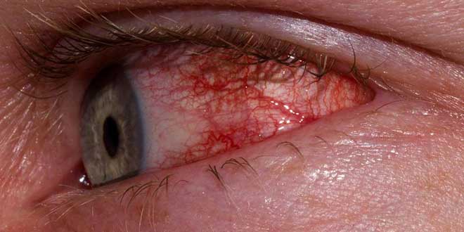 allergic conjunctivitis