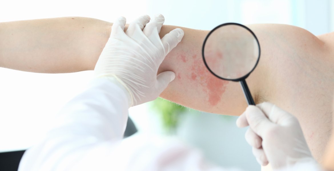It is difficult to diagnose except by an expert.. 5 skin disorders that you may mistakenly think are urticaria
