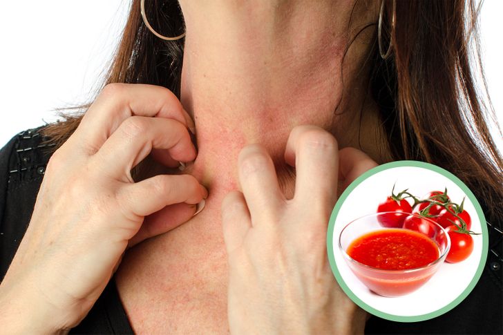 What Is Tomato Allergy? Symptoms, Causes, and Management