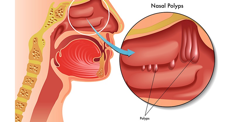 Nasal Polyps: Causes, Symptoms, Diagnosis, and Treatment